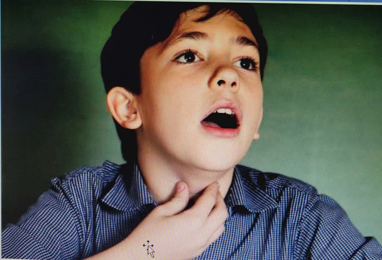 Rối loạn ngôn ngữu do phát âm